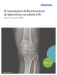 Il trattamento dell`osteoartrite di ginocchio con ortesi AFO