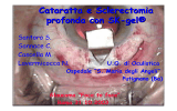 1_Cataratta e Sclerectomia profonda con SK-gel
