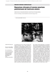 Riparazione chirurgica di enorme aneurisma postinfartuale del