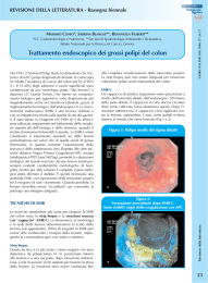 Trattamento endoscopico dei grossi polipi del colon