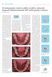 attacchi linguali bidimensionali 2D® nella pratica clinica