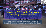 La placca NCB nelle fratture su chiodo pertrocanterico