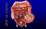 Neoplasie colon