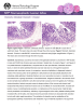 Stomach, Glandular Stomach – Erosion