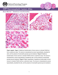 – Gelatinous transformation Bone Marrow